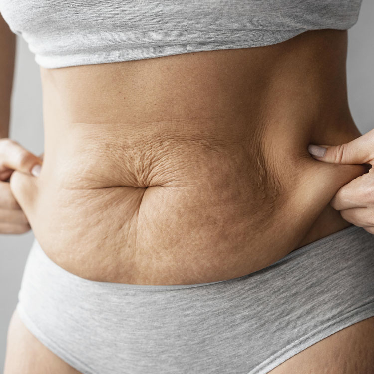 Tratamento para Flacidez Corporal - DS Clinic Custom Beauty