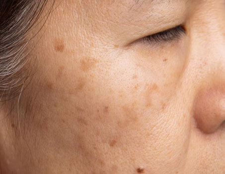 Tratamento para Melasma