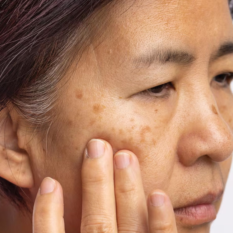 Tratamento para Melasma - DS Clinic Custom Beauty